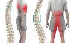 Cập nhật phương pháp điều trị đau thần kinh tọa